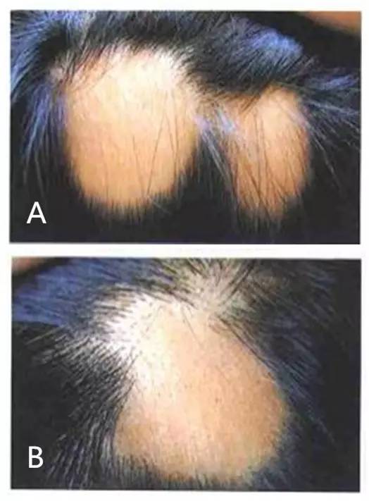 少年秃顶：关于儿童斑秃不得不说的事儿