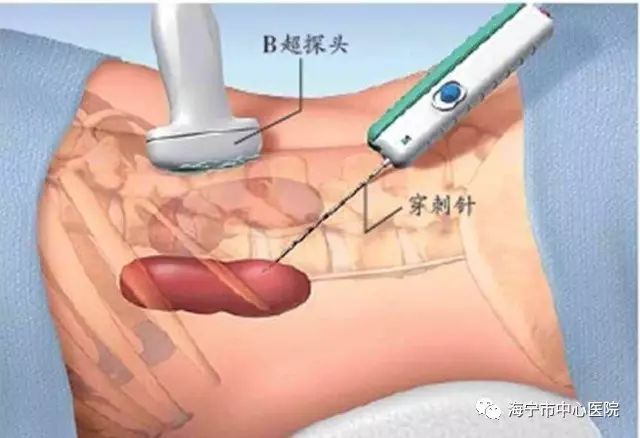 黄豆大肾囊肿成长五公分大小，不想开刀，纠结？ 别怕，下沉专家“