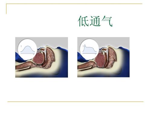 打鼾睡不好黑眼圈？那是因为没有呼吸机 