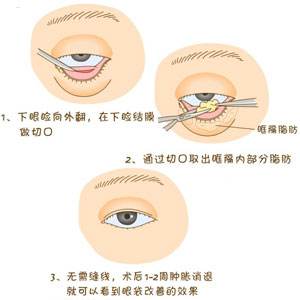 连化妆磨皮都没办法遮住的眼袋 小编这次终于把它除掉了